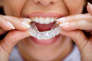 Dudas que van a surgirte antes de la ortodoncia invisible